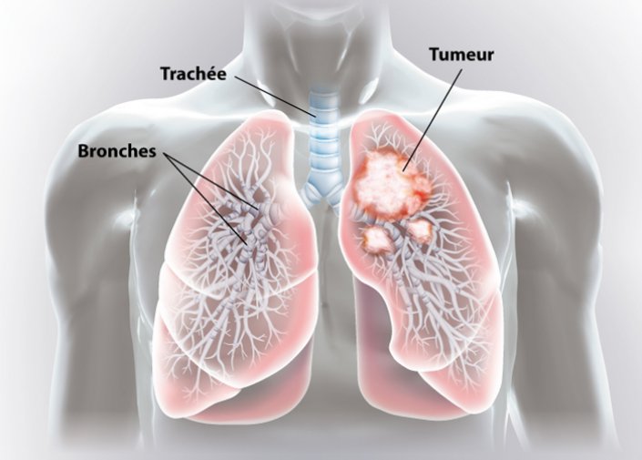 CENTRE Yaoundé Cancers du poumon : les traitements