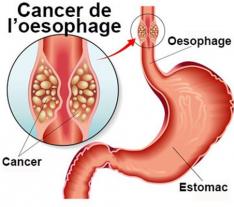 CENTRE Yaoundé LE CANCER DE L’ŒSOPHAGE
